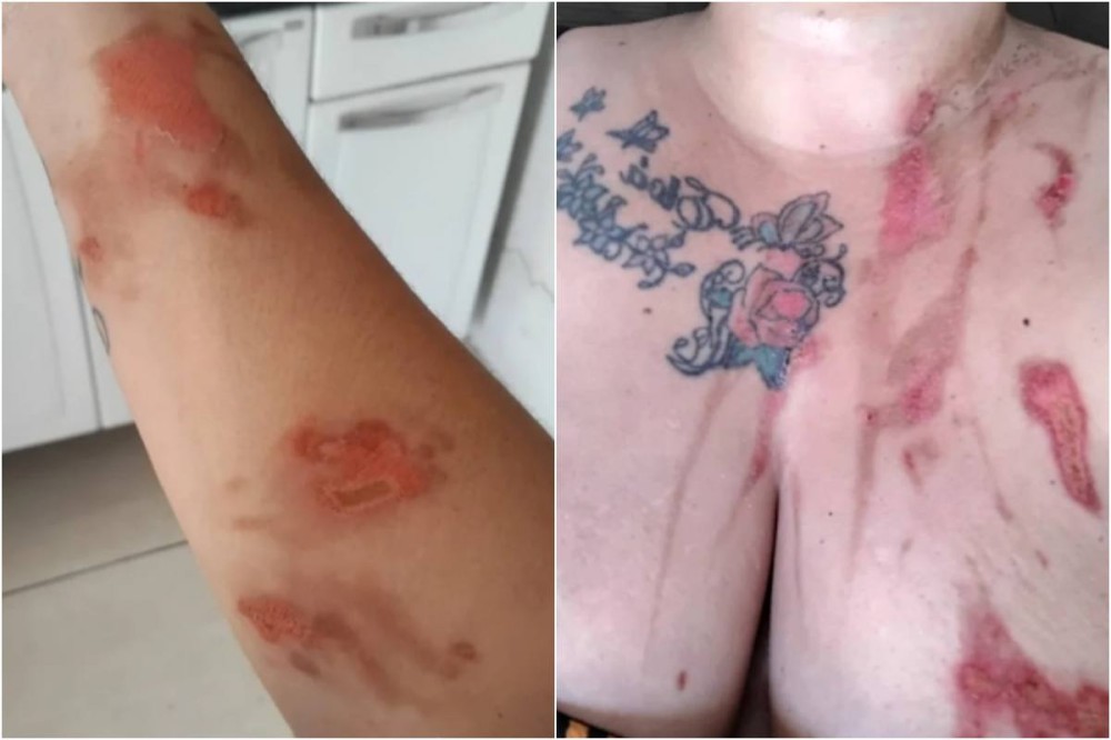 Ferimentos em mulher devido explosão de panela de pressão em Jaicós | Foto: Reprodução/Cidades na Net